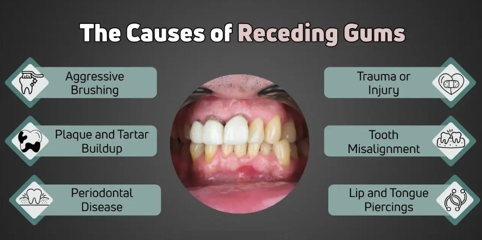 Common Causes of Gum Recession
