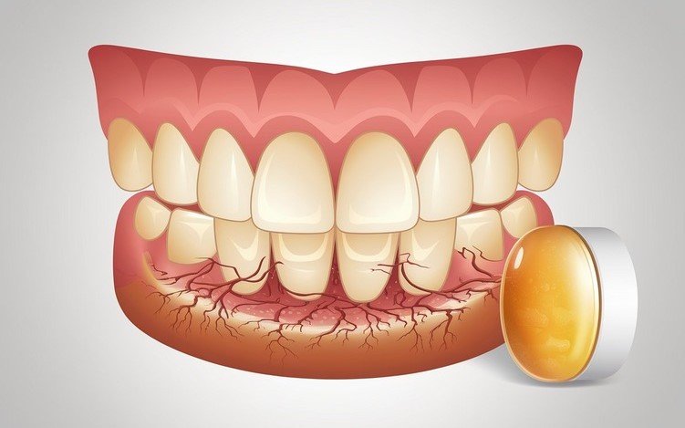 Signs Your Gums need Vitamin C